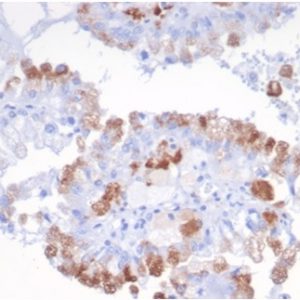 IHC analysis of formalin-fixed, paraffin-embedded human Renal carcinoma. Stained using SREBP2/1580 at 2ug/ml in PBS for 30min RT. HIER: Tris/EDTA, pH9.0, 45min. 2°C: HRP-polymer, 30min. DAB, 5min.