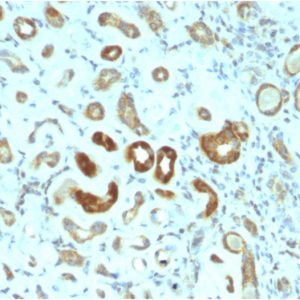 Formalin-fixed, paraffin-embedded human Renal Cell Carcinoma stained with STAT3 Mouse Monoclonal Antibody (STAT3/2409).