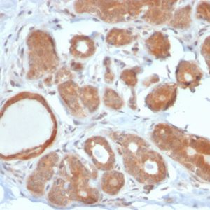 Formalin-fixed, paraffin-embedded human Breast Carcinoma stained with STAT5B Mouse Monoclonal Antibody (STAT5B/2611).