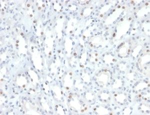 Formalin-fixed, paraffin-embedded human renal cell carcinoma stained with STAT6 Mouse Monoclonal Antibody (STAT6/2410). HIER: Tris/EDTA, pH9.0, 45min. 2 °: HRP-polymer, 30min. DAB, 5min.