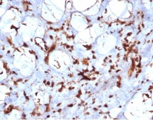 Formalin-fixed, paraffin-embedded human liposarcoma stained with STAT6 Recombinant Rabbit Monoclonal Antibody (STAT6/7163R). HIER: Tris/EDTA, pH9.0, 45min. 2°C: HRP-polymer, 30min. DAB, 5min.
