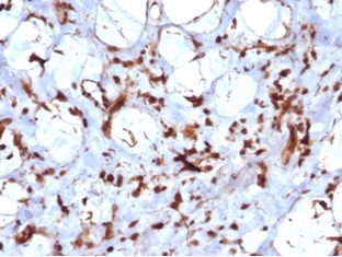 Formalin-fixed, paraffin-embedded human liposarcoma stained with STAT6 Recombinant Rabbit Monoclonal Antibody (STAT6/7163R). HIER: Tris/EDTA, pH9.0, 45min. 2 °: HRP-polymer, 30min. DAB, 5min.