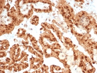 Formalin-fixed, paraffin-embedded human renal cell carcinoma stained with STAT6 Recombinant Rabbit Monoclonal Antibody (STAT6/7163R).
