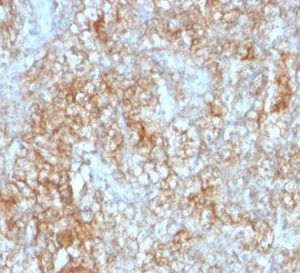 Formalin-fixed, paraffin-embedded human renal cell carcinoma stained with CD147 Mouse Monoclonal Antibody (8D6).