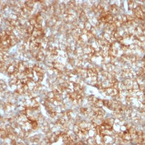 Formalin-fixed, paraffin-embedded human Renal Cell Carcinoma stained with CD147 Mouse Monoclonal Antibody (BSG/963).