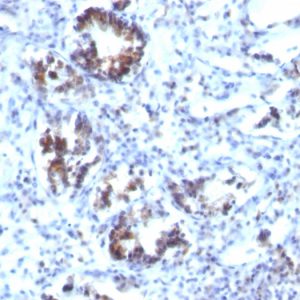 Formalin-fixed, paraffin-embedded human Colon Carcinoma stained with Transgelin Monoclonal Antibody (SPM606)