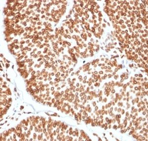 Formalin-fixed, paraffin-embedded human bladder carcinoma stained with TCF4 Mouse Monoclonal Antibody (TCF4/2252) at 2ug/ml. HIER: Tris/EDTA, pH9.0, 45min. 2°C: HRP-polymer, 30min. DAB, 5min.