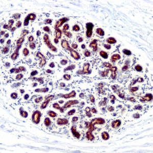 Formalin-fixed, paraffin-embedded human Breast Carcinoma stained with pS2 Mouse Monoclonal Antibody (GE2).
