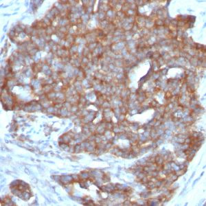 Formalin-fixed, paraffin-embedded human Ovarian Carcinoma stained with pS2 Monoclonal Antibody (SPM313).