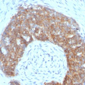 Formalin-fixed, paraffin-embedded human Ovarian Carcinoma stained with pS2 Mouse Monoclonal Antibody (SPM313).