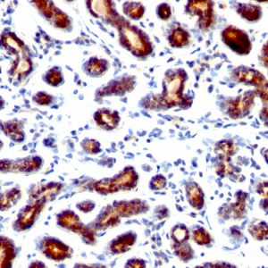 Formalin-fixed, paraffin-embedded human breast Carcinoma stained with pS2 Monoclonal Antibody (TFF1/1091).