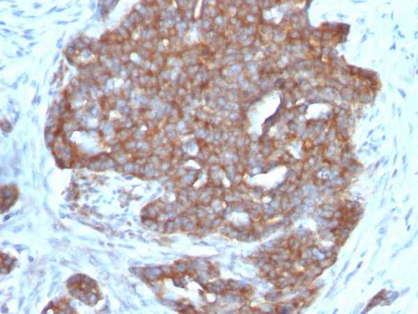 Formalin-fixed, paraffin-embedded human Ovarian Carcinoma stained with pS2 Monoclonal Antibody (TFF1/1091).