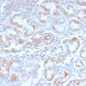 Formalin-fixed, paraffin-embedded human Stomach Carcinoma stained with pS2 Rabbit Recombinant Monoclonal Antibody (TFF1/2969R).