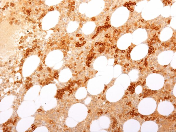 Formalin-fixed, paraffin-embedded human Bone Marrow stained with CD71 Mouse Monoclonal Antibody (TFRC/1817).