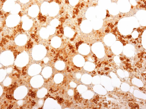 Formalin-fixed, paraffin-embedded human Bone Marrow stained with CD71 Mouse Monoclonal Antibody (TFRC/1818).