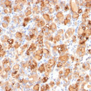 Formalin-fixed, paraffin-embedded human Thyroid stained with Thyroglobulin Mouse Recombinant Monoclonal Antibody (r2H11).