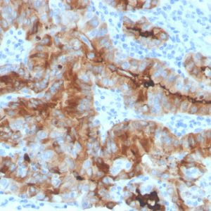 Formalin-fixed, paraffin-embedded human thyroid carcinoma stained with Thyroglobulin Mouse Recombinant Monoclonal Antibody (rTGB/4744).