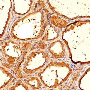 Formalin-fixed, paraffin-embedded human Thyroid stained with  Thyroglobulin Mouse Monoclonal Antibody (6E1).