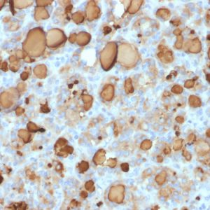 Formalin-fixed, paraffin-embedded human Thyroid Carcinoma stained with Thyroglobulin Mouse Recombinant Monoclonal Antibody (rTGB24).
