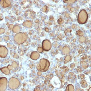 Formalin-fixed, paraffin-embedded human Thyroid stained with Thyroglobulin Rabbit Recombinant Monoclonal Antibody (TGB/1970R).