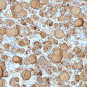 Formalin-fixed, paraffin-embedded human Thyroid Carcinoma stained with Thyroglobulin Rabbit Recombinant Monoclonal Antibody (TGB/1968R).