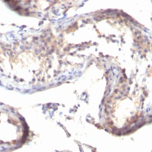 Formalin-fixed, paraffin-embedded human Testicular Carcinoma stained with TGF alpha Mouse Monoclonal Antibody (MF9)
