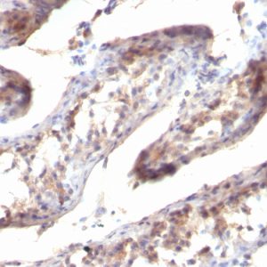 Formalin-fixed, paraffin-embedded human Testicular Carcinoma stained with TGF alpha Mouse Monoclonal Antibody (SPM357)