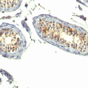 Formalin-fixed, paraffin-embedded human Testicular Carcinoma stained with TGF alpha Monoclonal Antibody (P/T1)