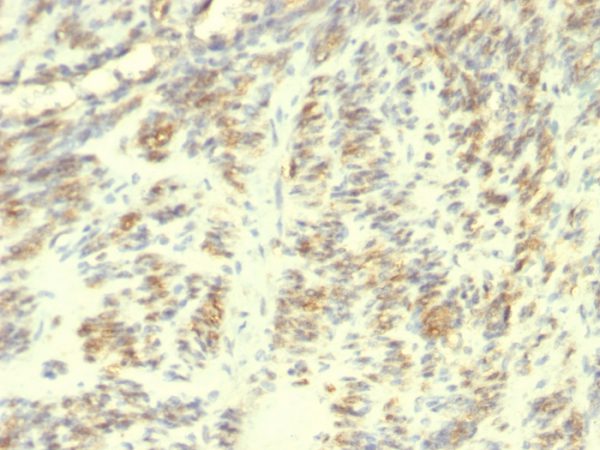 Formalin-fixed, paraffin-embedded human leiomyosarcoma stained with Transglutaminase II Mouse Monoclonal Antibody (TGM2/419).