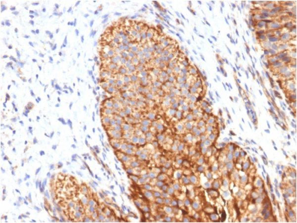 Formalin-fixed, paraffin-embedded human Bladder Carcinoma stained with Thrombomodulin Monoclonal/CD141 Antibody (THBD/1591).