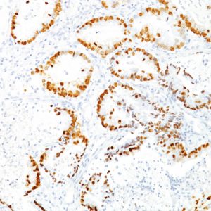 Formalin-fixed, paraffin-embedded human Lung Adenocarcinoma stained with TTF-1 Mouse Monoclonal Antibody (8G7G3/1).