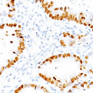 Formalin-fixed, paraffin-embedded human lung adenocarcinoma stained with TTF-1 Mouse Monoclonal Antibody (NX2.1/690). HIER: Tris/EDTA, pH9.0, 45min. 2°C: HRP-polymer, 30min. DAB, 5min.