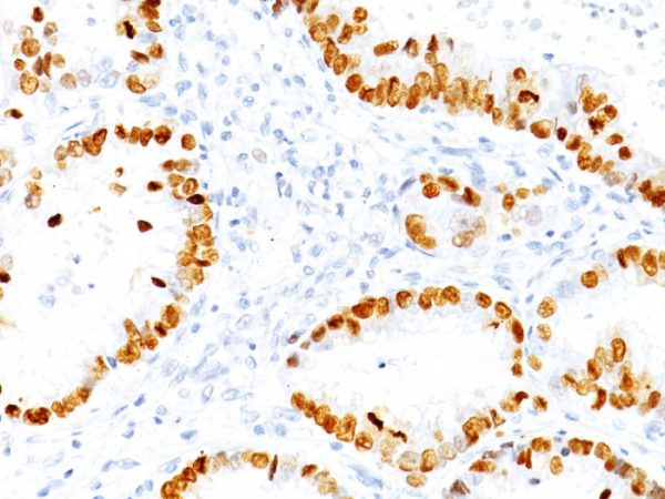 Formalin-fixed, paraffin-embedded human lung adenocarcinoma stained with TTF-1 Mouse Monoclonal Antibody (NX2.1/690). HIER: Tris/EDTA, pH9.0, 45min. 2°C: HRP-polymer, 30min. DAB, 5min.