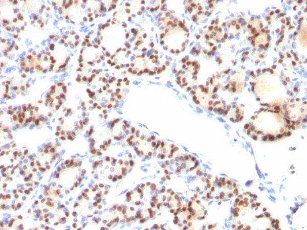 Formalin-fixed, paraffin-embedded human thyroid stained with TTF-1 Mouse Monoclonal Antibody (NX2.1/690). HIER: Tris/EDTA, pH9.0, 45min. 2°C: HRP-polymer, 30min. DAB, 5min.