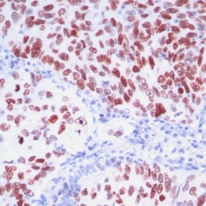 Formalin-fixed, paraffin-embedded human Lung Adenocarcinoma stained with TTF-1 Monoclonal Antibody (8G7G3/1 + NX2.1/690)