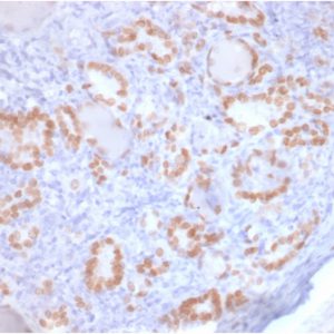 Formalin-fixed, paraffin-embedded human Lung Adenocarcinoma stained with TTF-1 Mouse Recombinant Monoclonal Antibody (rNX2.1/690).