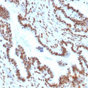 Formalin-fixed, paraffin-embedded human Endometrial Carcinoma stained with TLE1 Mouse Monoclonal Antibody (TLE1/2051).