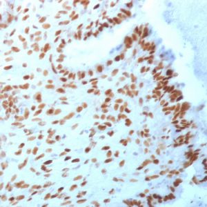 Formalin-fixed, paraffin-embedded human Endometrial Carcinoma stained with TLE1 Mouse Monoclonal Antibody (TLE1/2062).