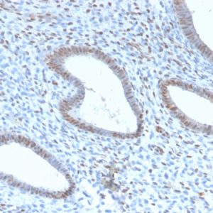 Formalin-fixed, paraffin-embedded human endometrial carcinoma stained with TLE1 Rabbit Recombinant Monoclonal Antibody (TLE1/2946R). HIER: Tris/EDTA, pH9.0, 45min. 2: HRP-polymer, 30min. DAB, 5min.