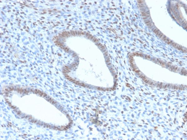 Formalin-fixed, paraffin-embedded human Endometrial Carcinoma stained with TLE1 Rabbit Recombinant Monoclonal Antibody (TLE1/2946R).