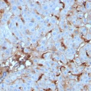 Formalin-fixed, paraffin-embedded human Renal Cell Carcinoma stained with C1QA Mouse Monoclonal Antibody (C1QA/2955).