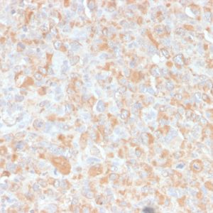 Formalin-fixed, paraffin-embedded human Histiocytoma stained with TNF alpha Mouse Monoclonal Antibody (4C6-H8).