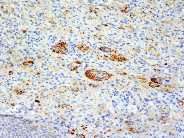 Formalin-fixed, paraffin-embedded human Erdheim-Chester disease (also known as polyostotic sclerosing histiocytosis) stained with TNF alpha Mouse Monoclonal Antibody (TNFA/1172).