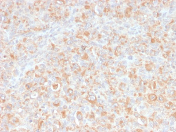 Formalin-fixed, paraffin-embedded human histiocytoma stained with TNF alpha Mouse Monoclonal Antibody (SPM543).
