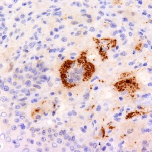 Formalin-fixed, paraffin-embedded human Erdheim-Chester disease (also known as polyostotic sclerosing histiocytosis) stained with TNF alpha Mouse Monoclonal Antibody (P/T2).