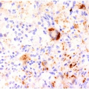 Formalin-fixed, paraffin-embedded human Erdheim-Chester disease (polyostoticsclerosing histiocytosis) stained with Tumor Necrosis Factor alpha Mouse Monoclonal Antibody (TNF706).