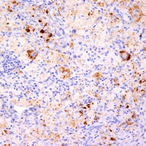 Formalin-fixed, paraffin-embedded human Erdheim-Chester disease (also known as polyostotic sclerosing histiocytosis). stained with TNF alpha Monoclonal Antibody (TNF706+P/T2).