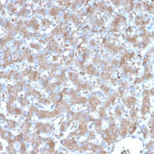 Formalin-fixed, paraffin-embedded human hepatocellular carcinoma stained with TNFAIP3 Mouse Monoclonal Antibody (TNFAIP3/2813).