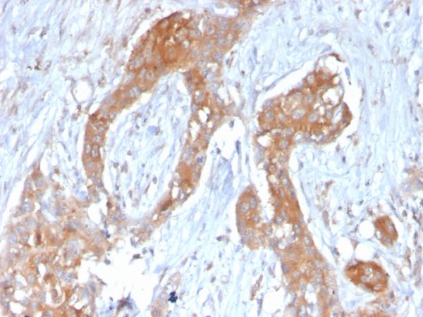 Formalin-fixed, paraffin-embedded human breast carcinoma stained with TNFAIP3 Mouse Monoclonal Antibody (TNFAIP3/2813).