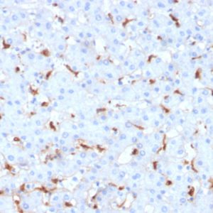 Formalin-fixed, paraffin-embedded human Hepatocellular Carcinoma stained with C1QB Mouse Monoclonal Antibody (C1QB/2961).